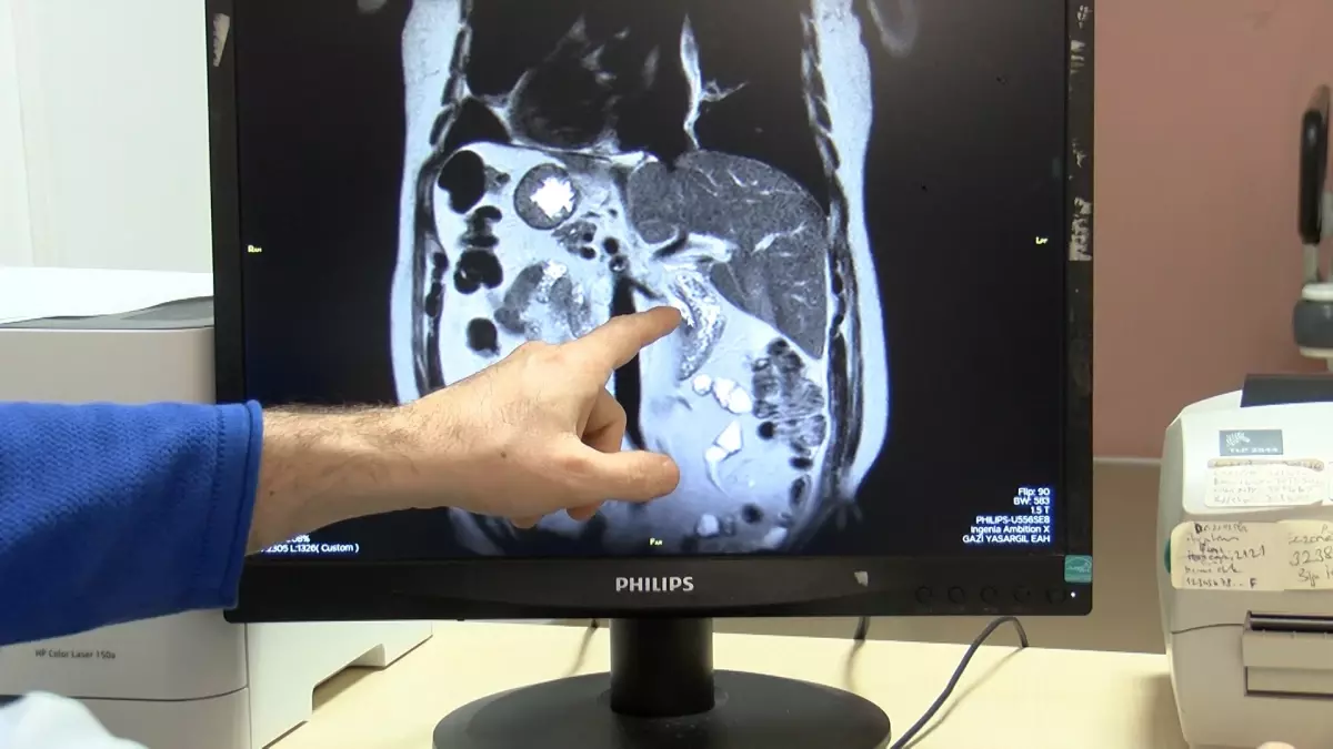 Diyarbakır’da Organları Ters Olan Hastaya Başarıyla ERCP İşlemi Uygulandı