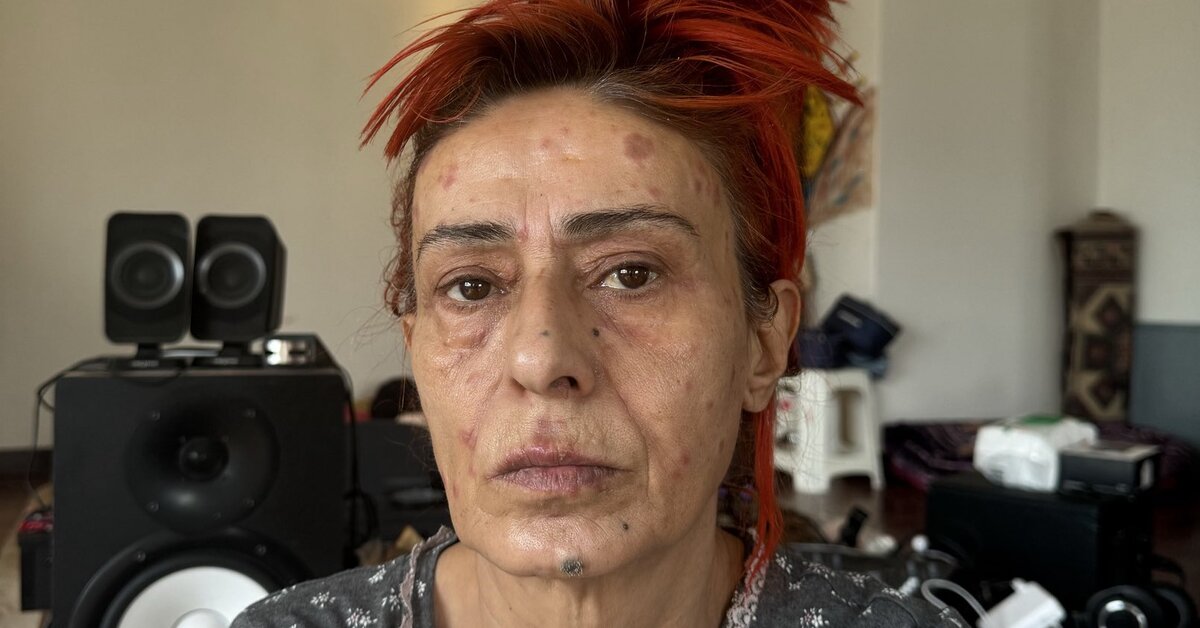 Yıldız Tilbe: Kimyasal yanık oldum